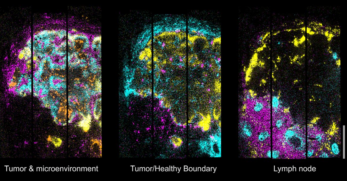 2D-Karte der Genexpression in einem metastasierten Lymphknoten. Foto: AG N. Rajewsky, Max Delbrück Center